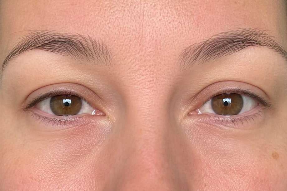 Illustrative phone-photo after view of the same under-eye area