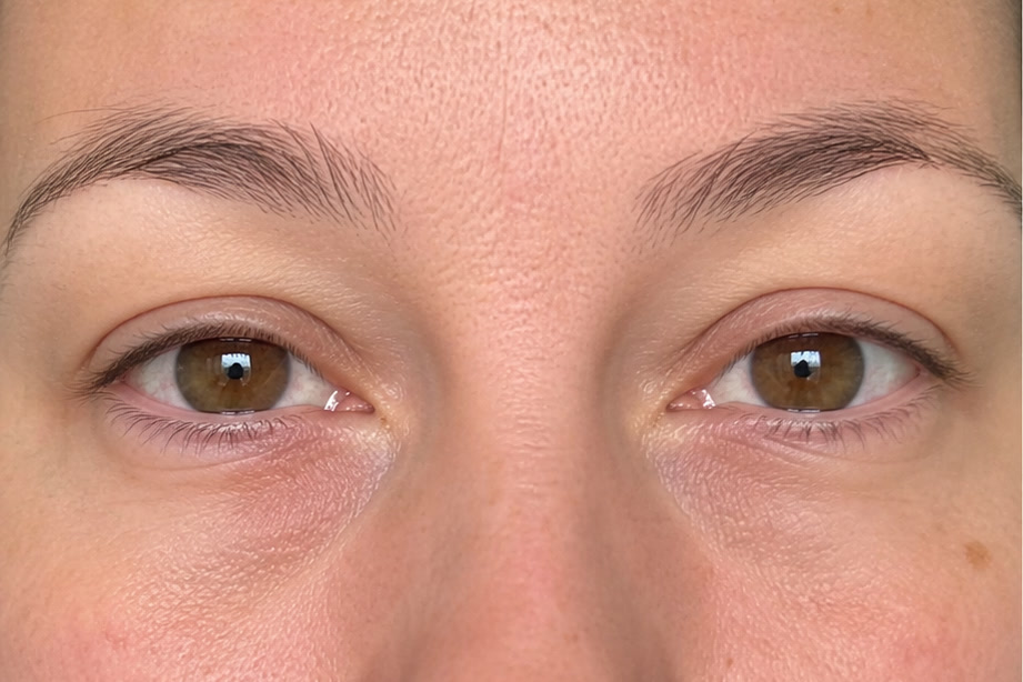 Illustrative phone-photo before view of the under-eye area